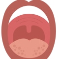 Can Dental Allergies Cause Swelling of the Lips or Tongue?