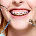 How To Manage Dental Allergies During Invisalign Treatment In Austin
