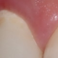 What Causes Dental Allergies and How to Avoid Them