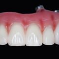 Sydney's Dental Allergies And Their Connection To All On Four Implant Prices