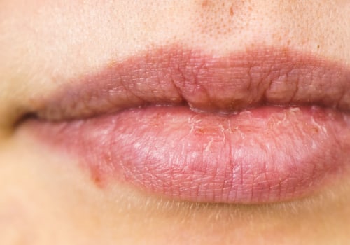 Treating Dental Allergies: What You Need to Know
