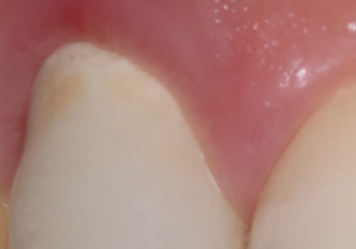 What Causes Dental Allergies and How to Avoid Them
