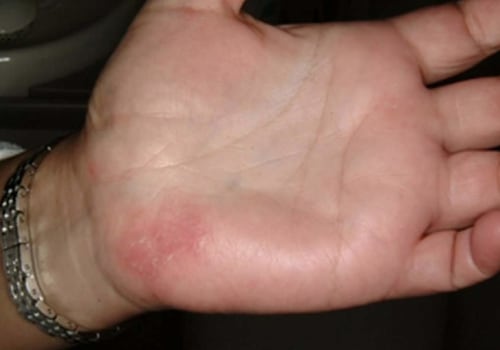 Are You Allergic to Dental Work?